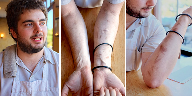 Adam Vickerman shows off his scars